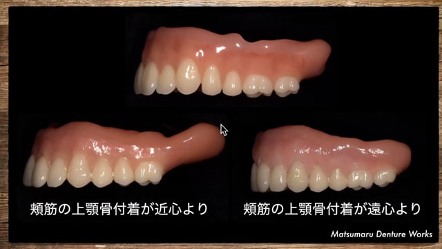 #2 全部床義歯製作に活かす解剖学 前編