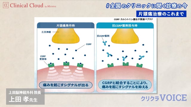 片頭痛治療 ～新しい抗体製剤の臨床経験～ Part1