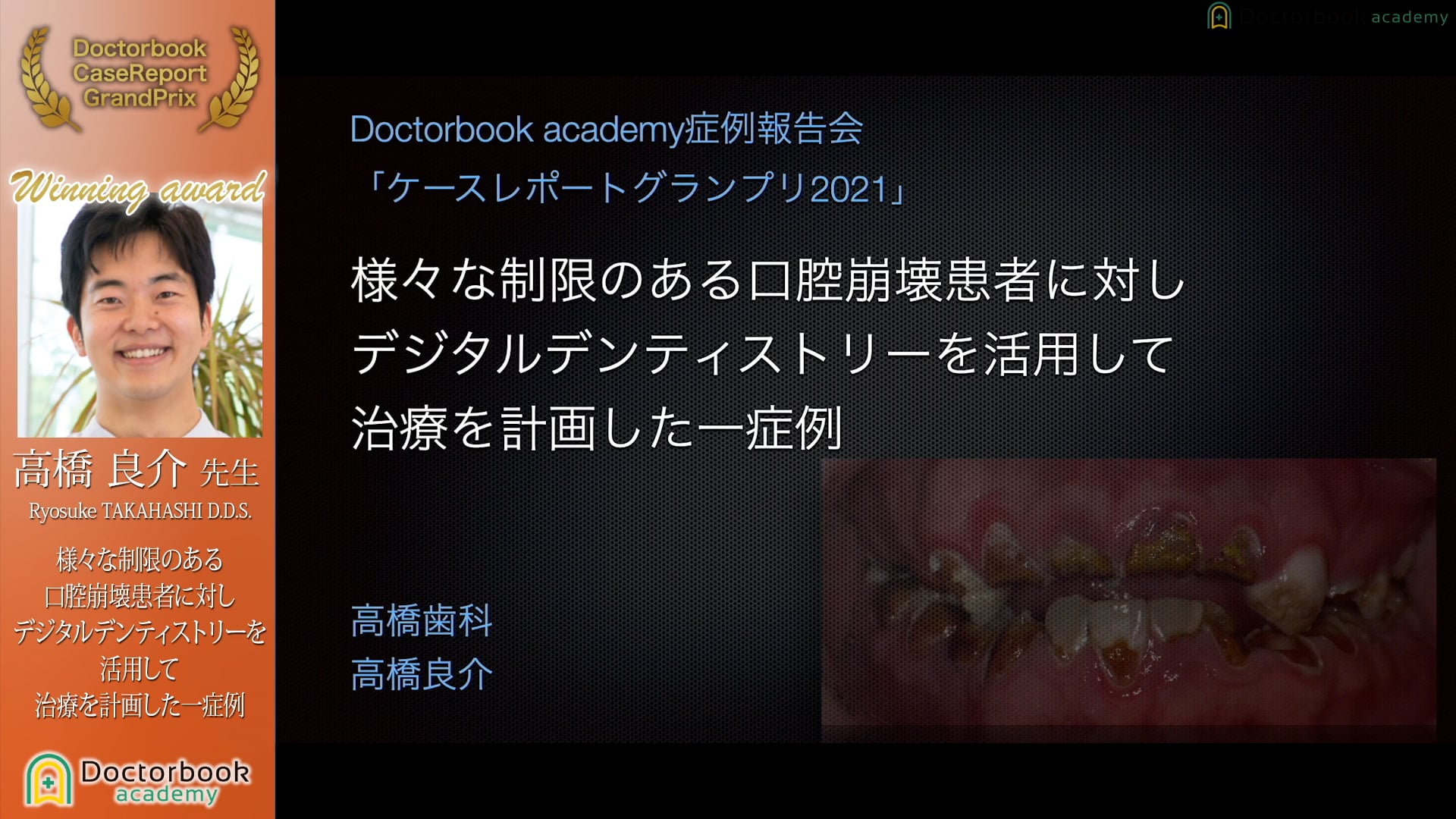 【第5回 ケースレポートGP全顎治療セッション 上位入賞】No.3 高橋良介先生「様々な制限のある口腔崩壊患者に対しデジタルデンティストリーを活用して治療を計画した一症例」