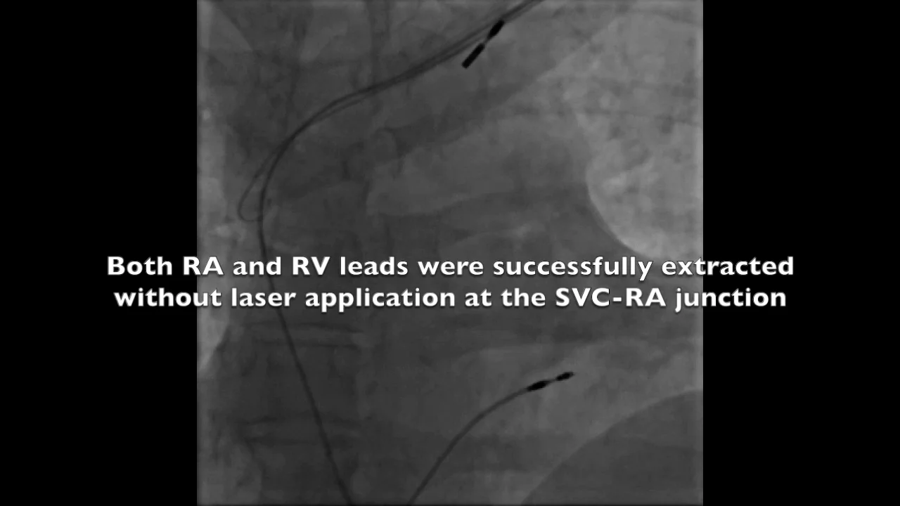 Amazon | Transvenous Lead Extraction: From Simple Traction