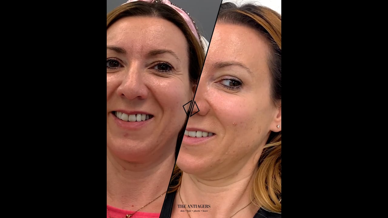 Botox για τις ρυτίδες έκφρασης