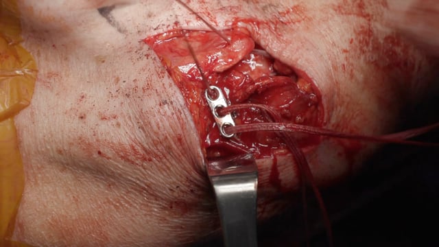 Open Repair of a Deltoid Tendon Rupture