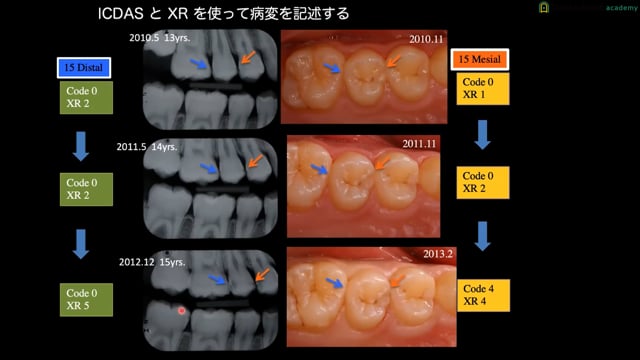 新しいう蝕治療をマスターしよう！「ICDASとXRをマスターしよう