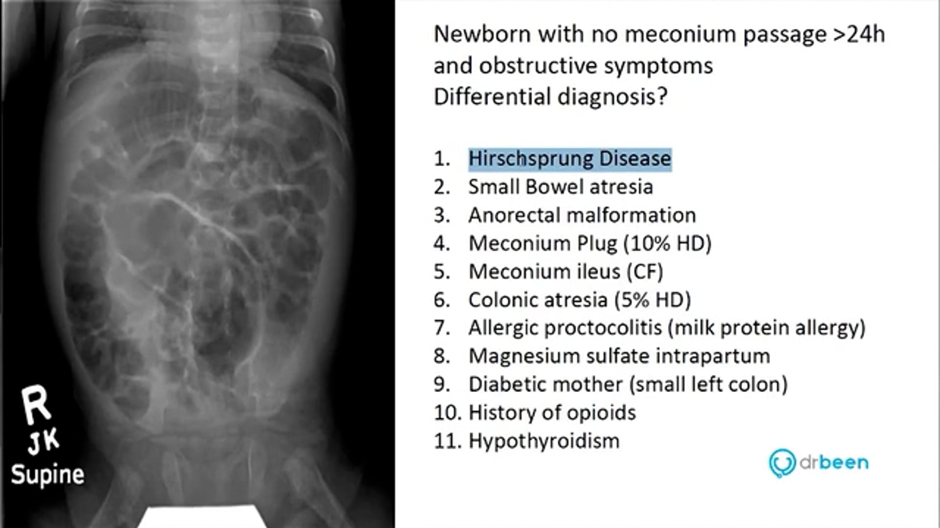 Hirschsprung Disease (Pediatric Surgery Series Lecture 1) by Dr. Marc A. Levitt, MD