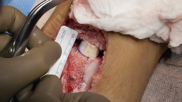 Combined Anterior Opening-Wedge High Tibial Osteotomy and Tibial Tubercle Osteotomy with Posterior Cruciate Ligament Reconstruct