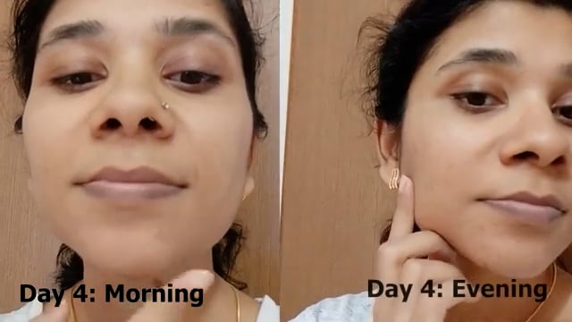 Wow ANTI ACNE FACE WASH | I used the product for 10 days & here's live results | Remove Pim