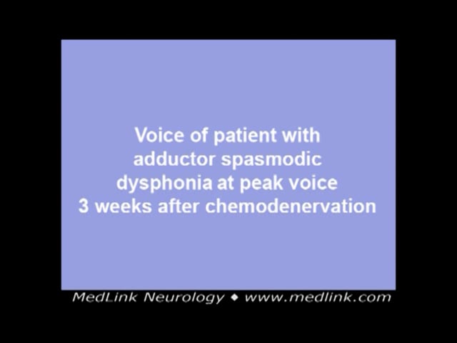 Adductor spasmodic dysphonia voice at peak after chemodenervation