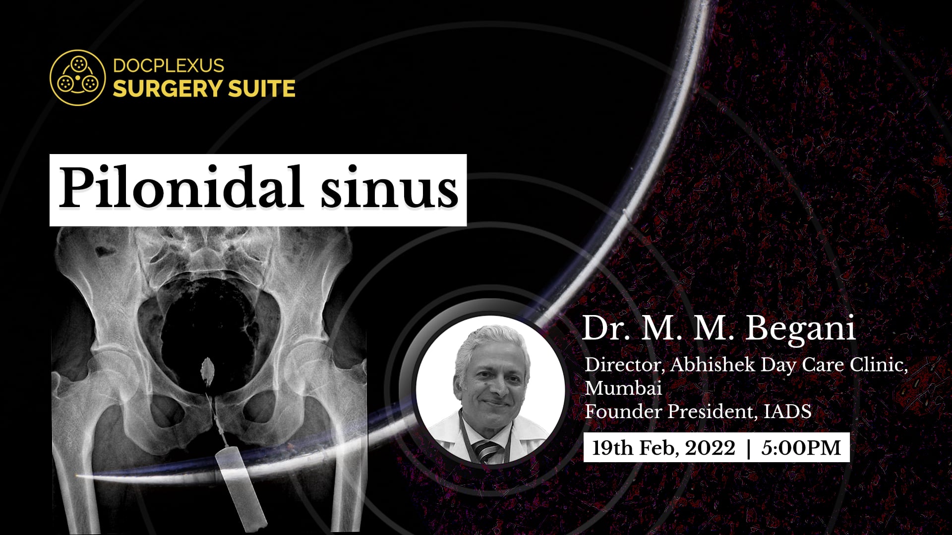 Pilonidal sinus