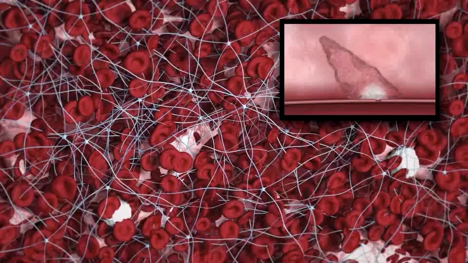 Cordis | MYNXGRIP Vascular Closure Device