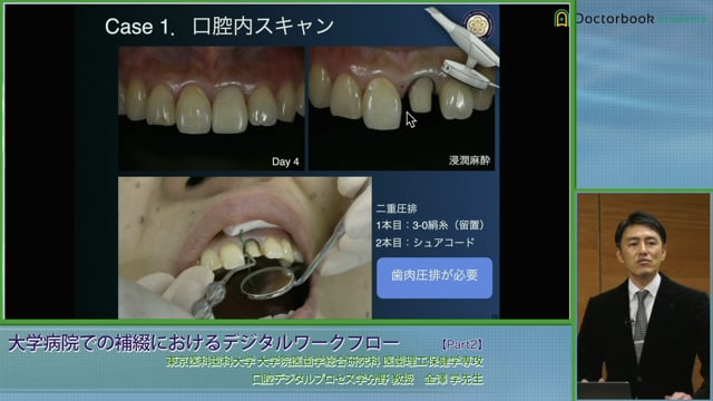 #2 デジタルワークフロー（間接法レジンコア築造〜支台歯のスキャン）