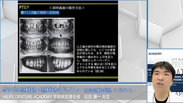 即時義歯の製作法、シングルデンチャー│歴史から学ぶ全部床義歯臨床 〜全部床義歯臨床のビブリオグラフィ〜 第11回