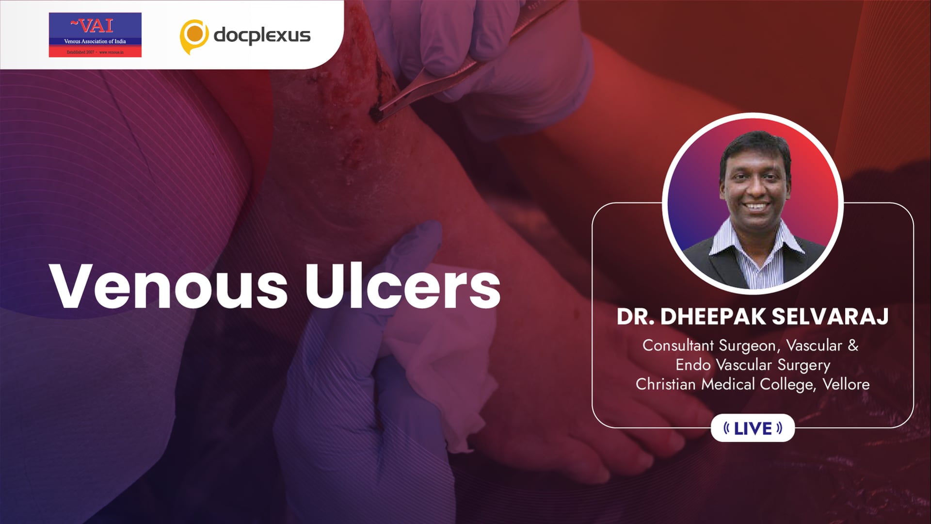 Venous Ulcers