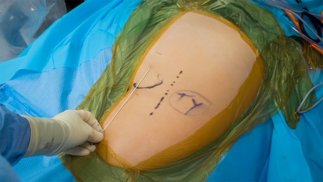 Endoscopic Repair of a Proximal Hamstring Tear