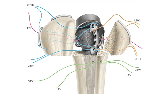 Shoulder Hemiarthroplasty for Proximal Humerus Fracture