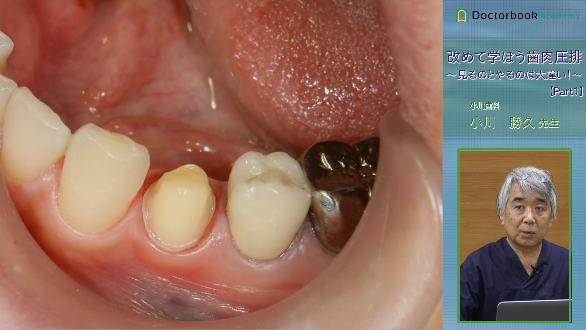 #1 支台歯形成時における歯肉圧排の役割