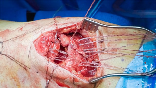 Primary Quadriceps Tendon Suture Anchor Repair