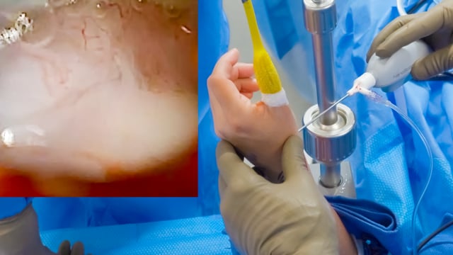 Thumb Basal Joint Arthroscopy Using a 2mm Needle Arthroscope