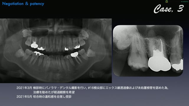 #3 予防拡大の必要性