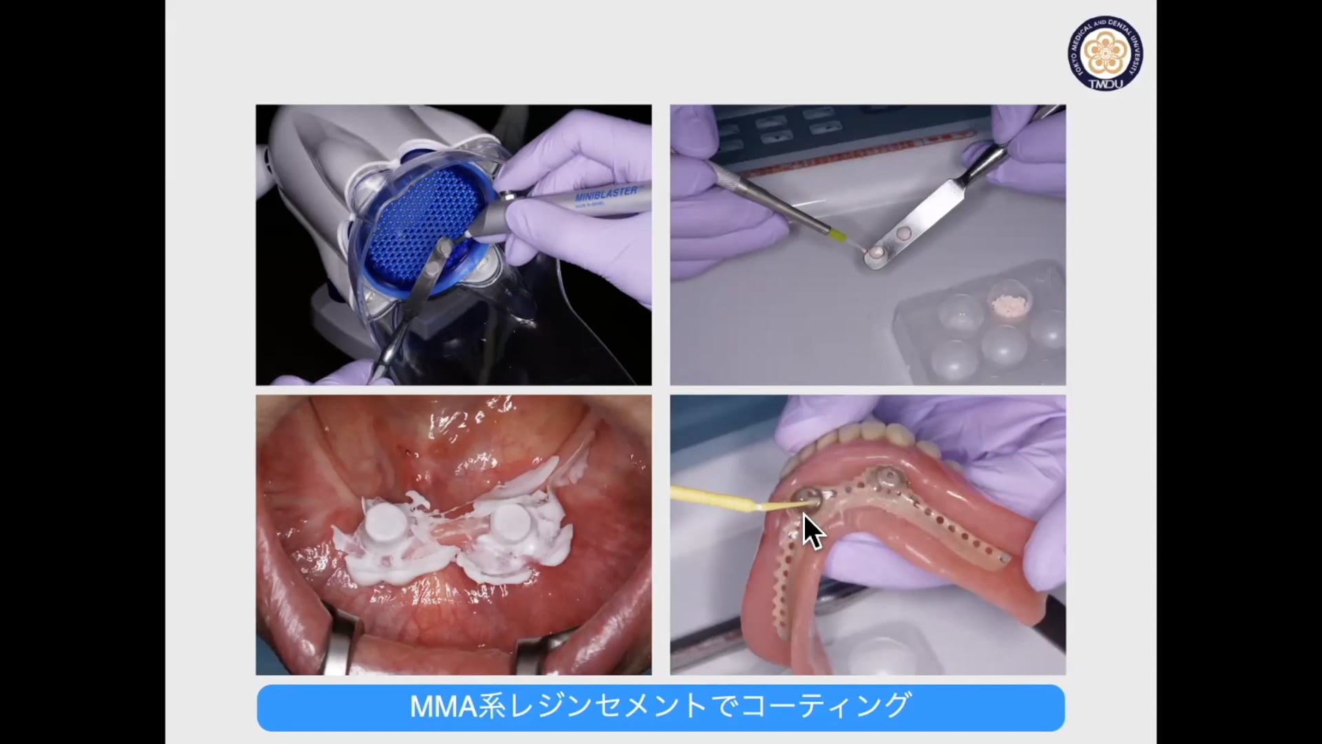 #2「磁性アタッチメントの選択と臨床ステップ」金澤学先生