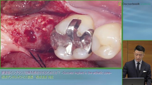 #2 骨補填材について / 欠損歯のインプラント症例