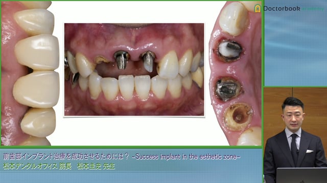 #4 前歯部保存不可能な症例とインプラント間乳頭について