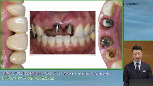 前歯部インプラント治療を成功させるためには？ | Doctorbook academy