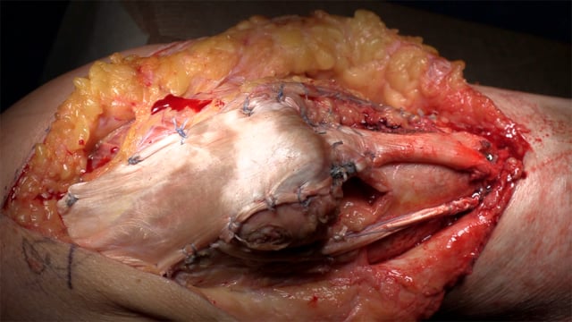 Chronic Extensor Mechanism Reconstruction using Achilles Allograft and Semitendinosus Autograft Augmentation