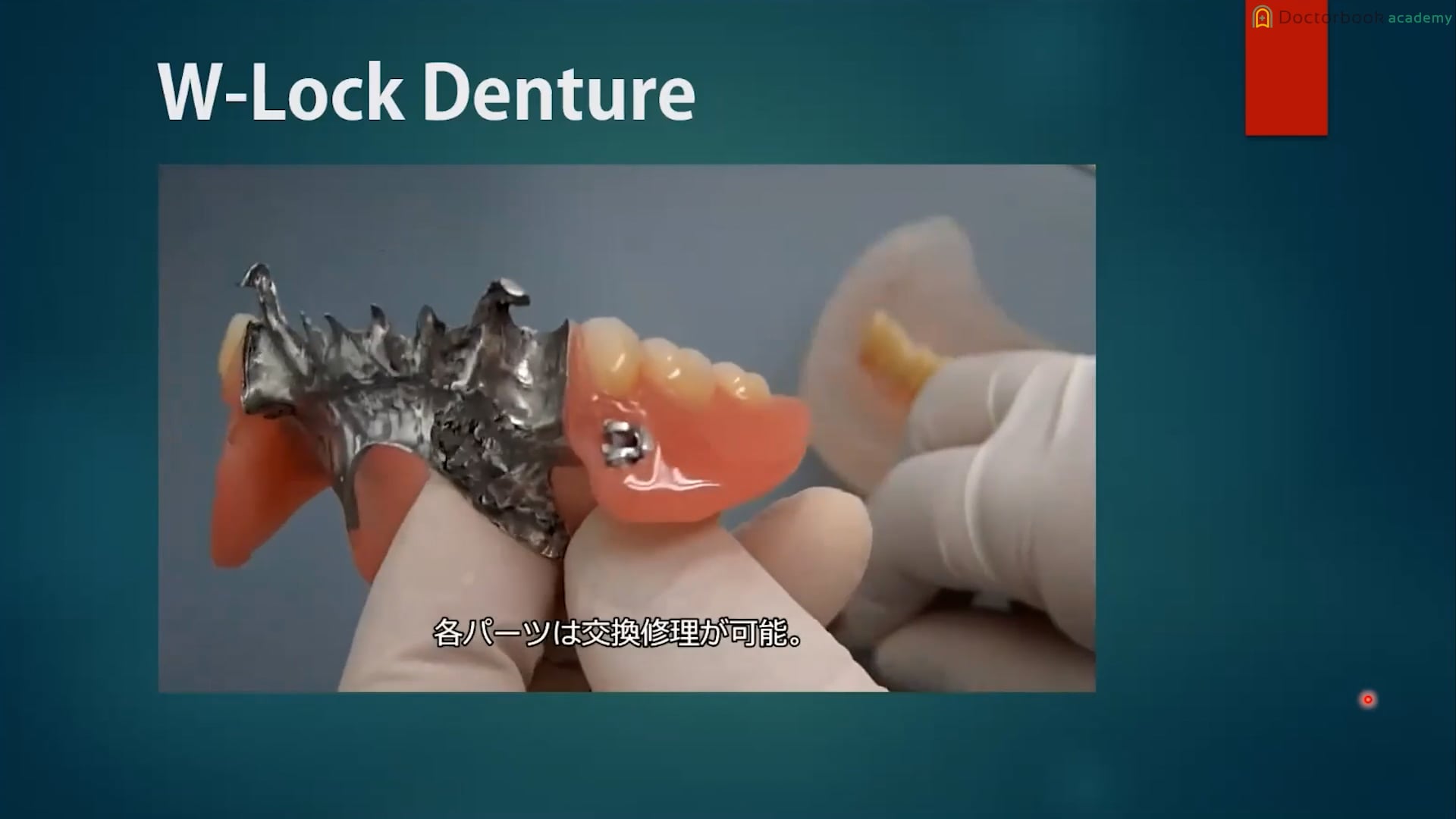 第4回 3ピースでウイングが小さい症例 #1 3ピースのW-Lock Denture