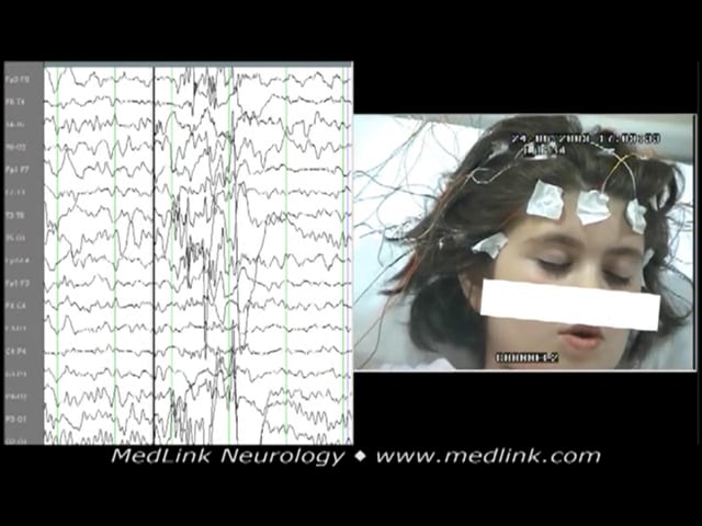 Facial (eyelid, perioral) myoclonia with typical absence seizures (EEG)