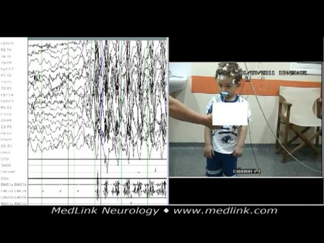 Myoclonic absence seizure of idiopathic (unknown)