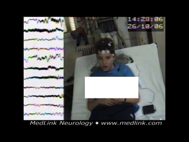 Myoclonic absence seizure of idiopathic (unknown) cause (1)