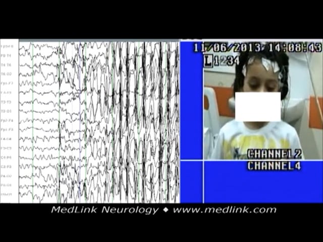 Absence seizures during hyperventilation with horizontal head jerking in a 5-year-old boy (EEG)