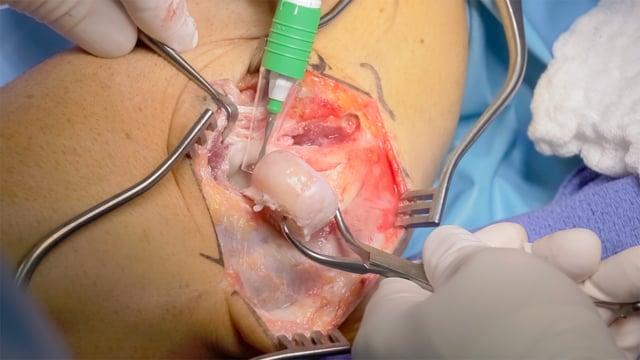 Radial Head Resection and Capsular Release