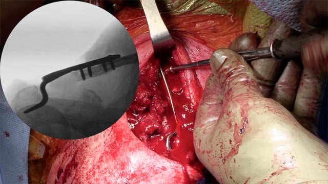 Revision Acromioclavicular Fixation with Clavicle Hook Plate for Failed Dog Bone Coracoclavicular Reconstruction