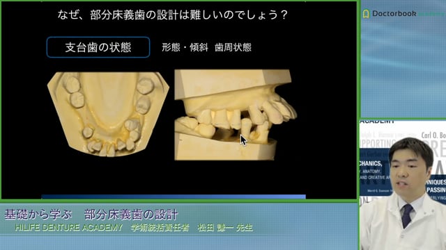 #1 なぜ部分床義歯の設計は難しいのか