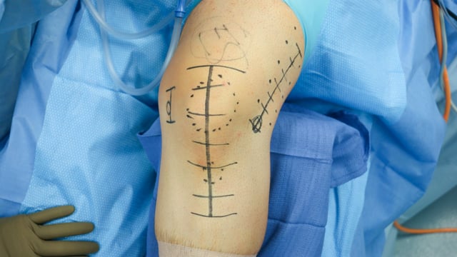 Combined DFO, TTO, and MPFL Reconstruction for Recurrent Patellar Instability