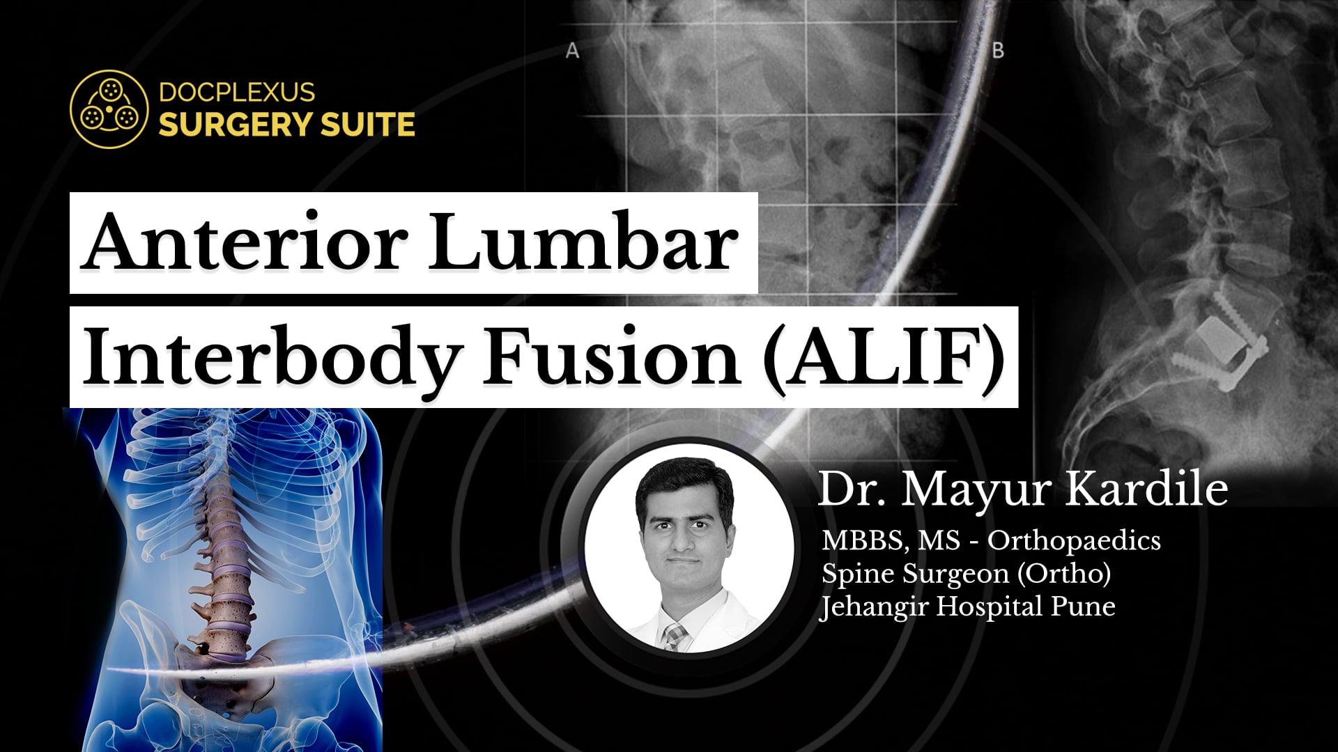 Anterior Lumbar Interbody Fusion (ALIF)