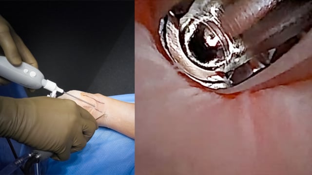 Bilateral Needle Arthroscopy-Assisted Plantaris Tendon Release