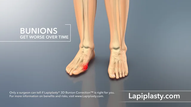 Lapiplasty: Learn All About This New, Breakthrough Bunion Surgery