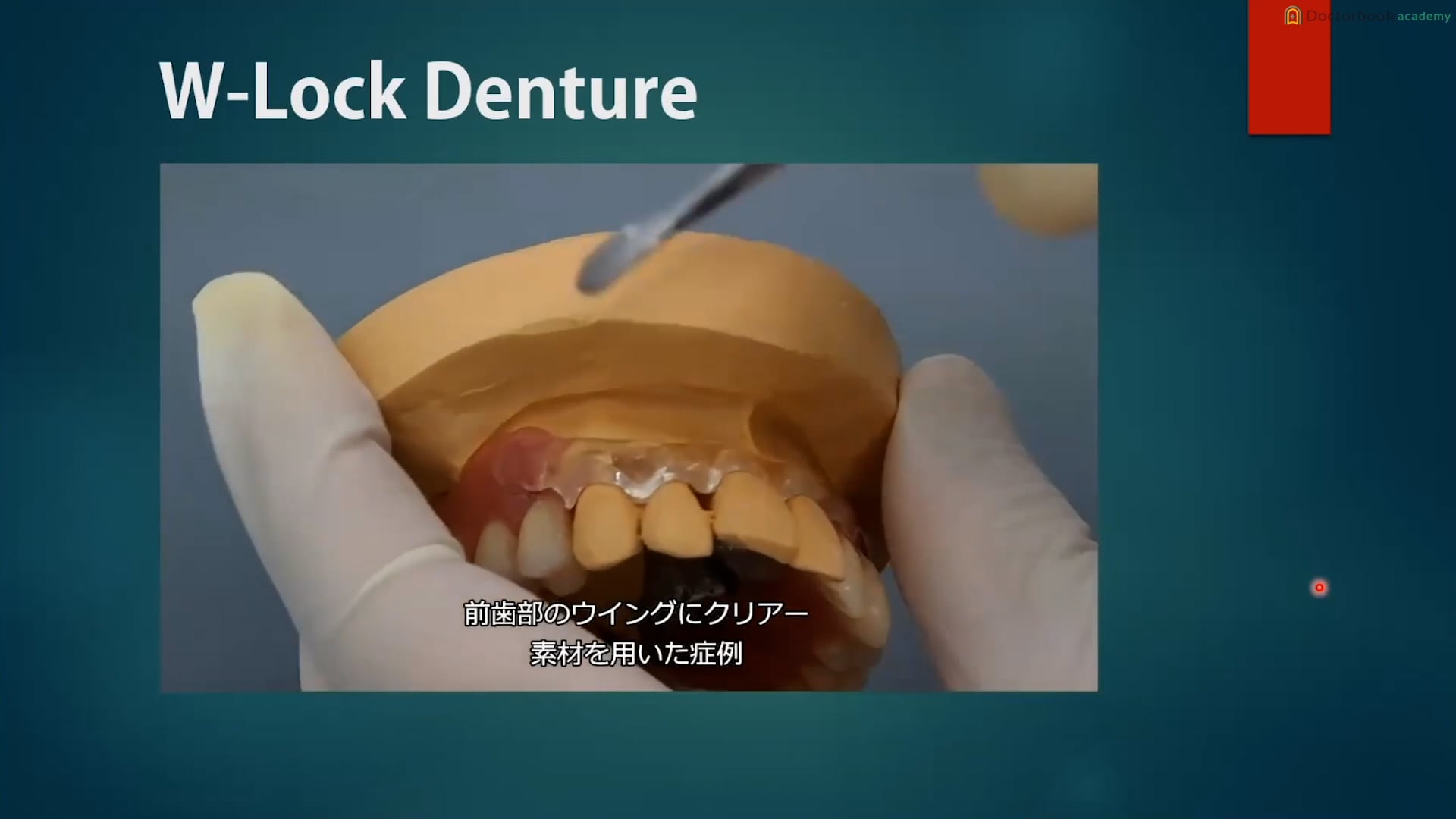 第5回 著しくフレアーアウトしている症例 #1 難症例におけるW-Lock Dentureの有用性