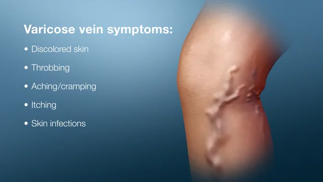 SVS: When do varicose veins need medical attention?