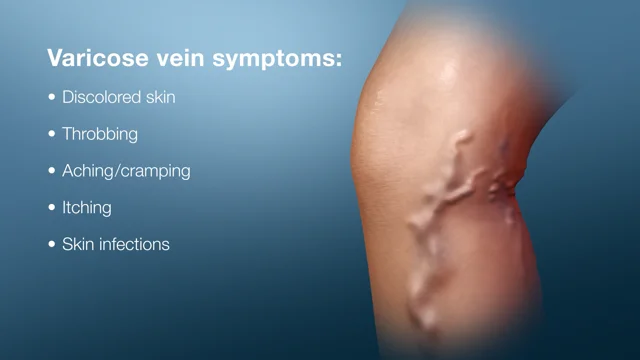 When to Worry About Varicose Veins: Symptoms & Treatment