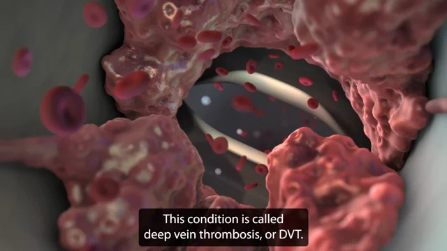 Venous Thromboembolism - What Is Venous Thromboembolism?