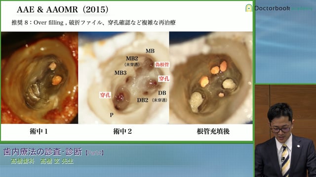 #4 歯髄炎・歯髄壊死の場合