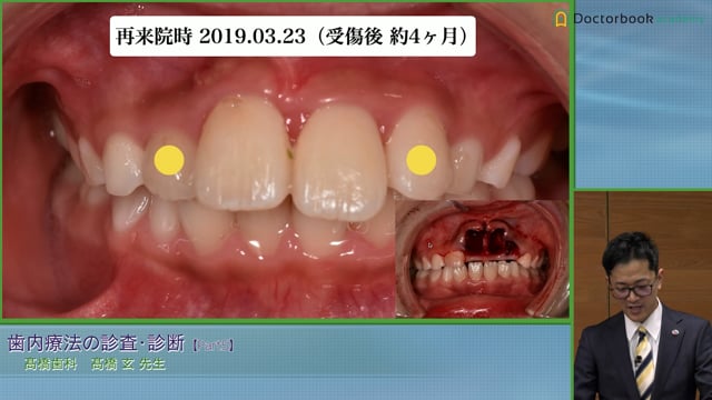 #5 外傷歯の場合