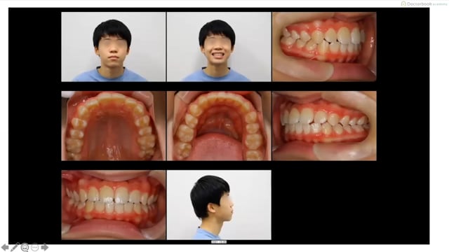 #2 歯並びを良くする取り組み / 押村侑希先生（歯科医師）