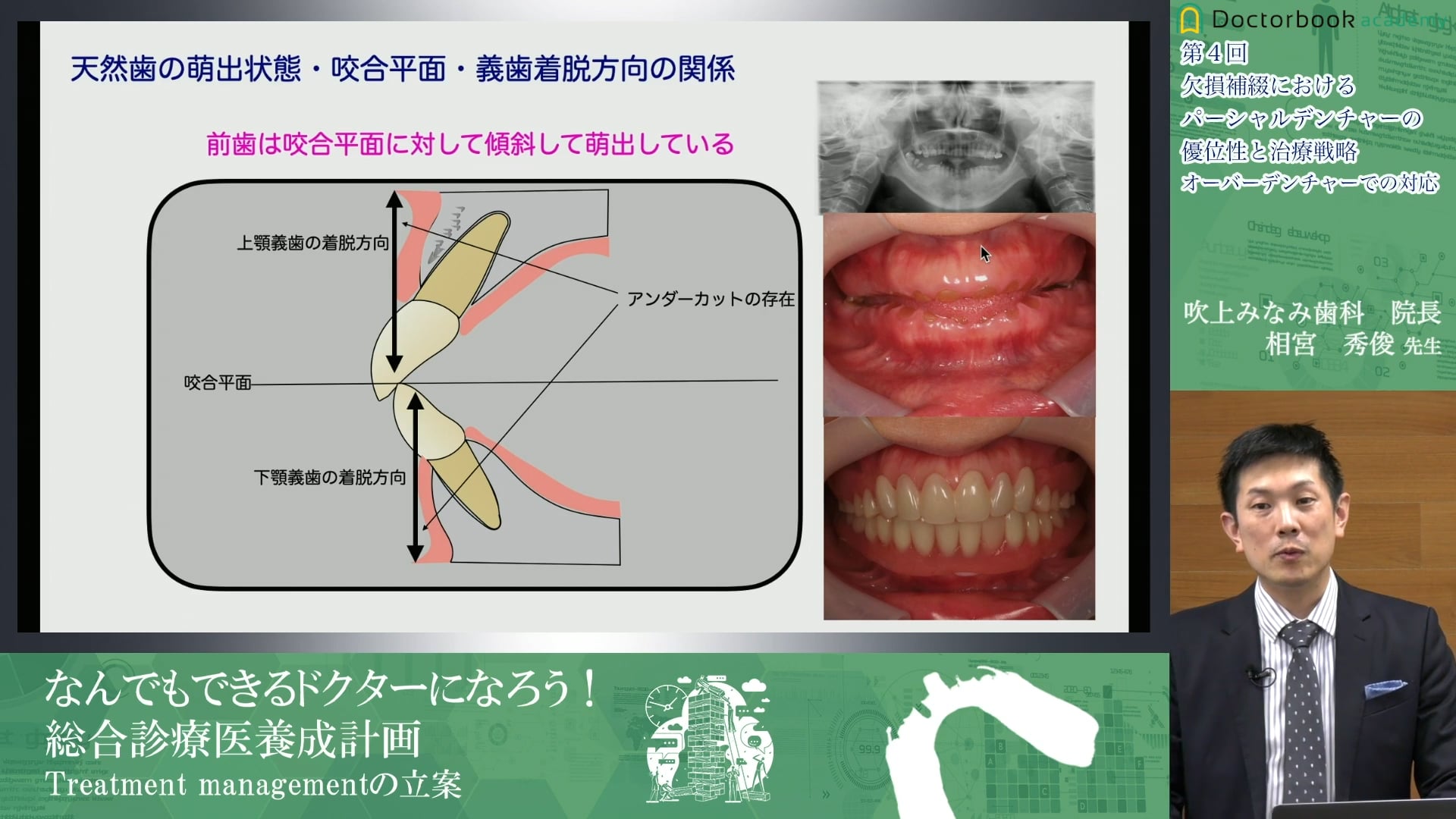 欠損補綴におけるパーシャルデンチャーの優位性と治療戦略　オーバーデンチャー編