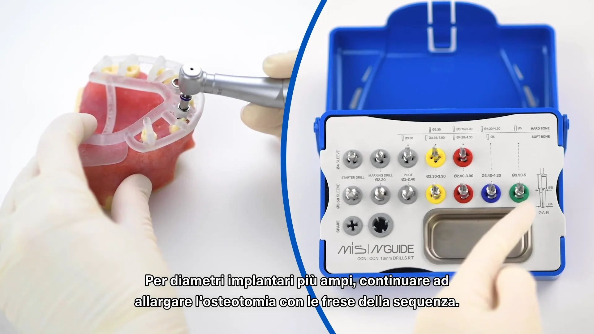 (IT Subtitles) Using the MGUIDE 16mm Kit on Vimeo