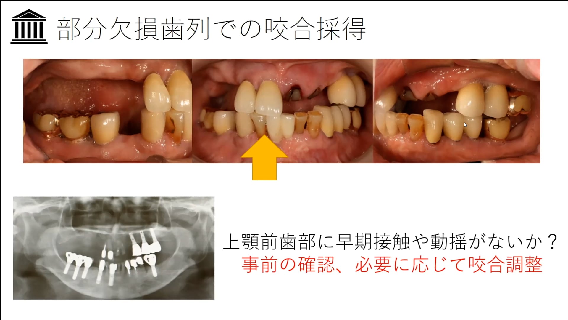 #2「咬合床を応用した部分欠損歯列の咬合採得」荻野 洋一郎先生