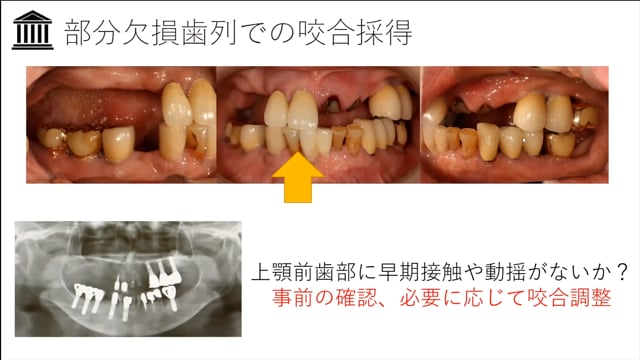 #2「咬合床を応用した部分欠損歯列の咬合採得」荻野 洋一郎先生